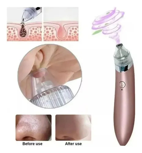 Kit SkinCare Pro™ 5 en 1 – Limpiador Facial Profundo + Extractor de Puntos Negros